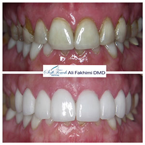 Best Porcelain Veneers San Diego