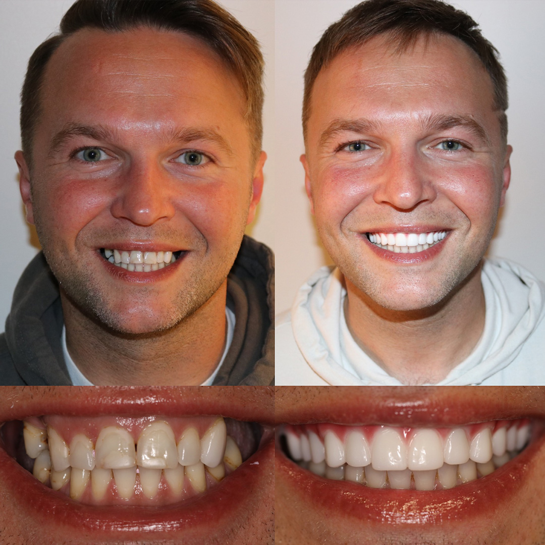 All On Four Before and After 06