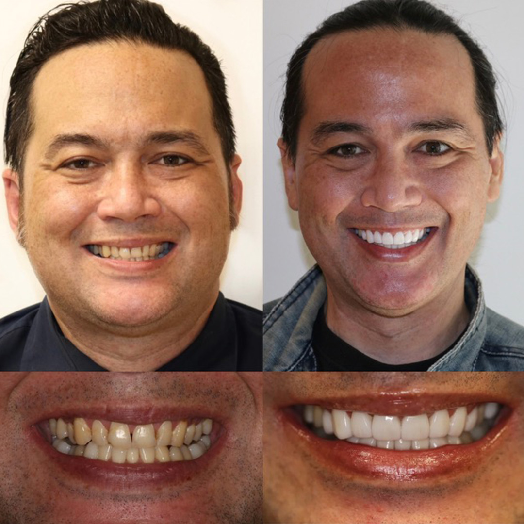 All On Four Before and After 06