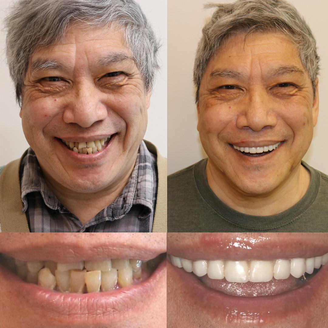 All On Four Before and After 06