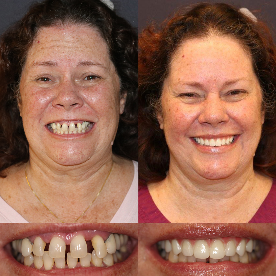All On Four Before and After 06