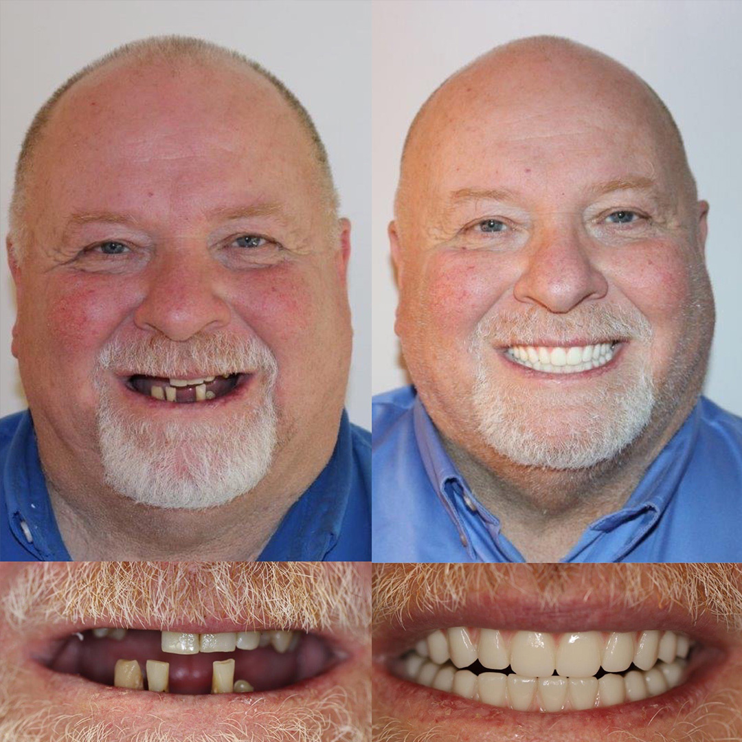All On Four Before and After 06