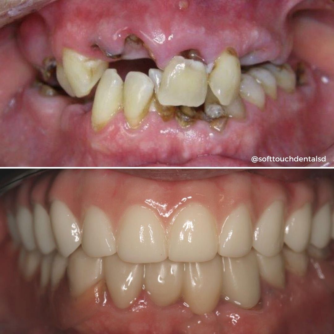 All On Four Before and After 06