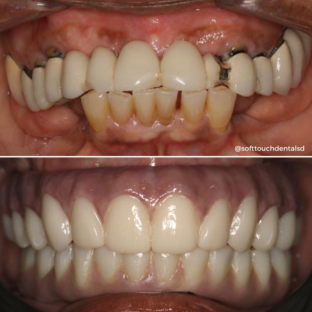 All On Four Before and After 06