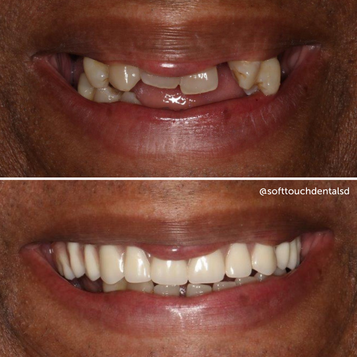 All On Four Before and After 06