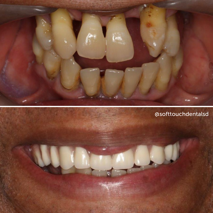 All On Four Before and After 09