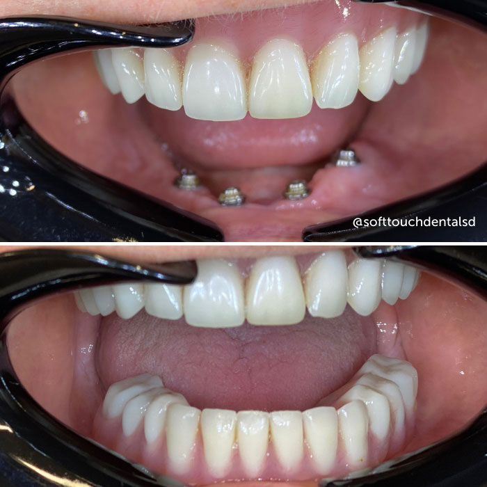 All On Four Before and After 06