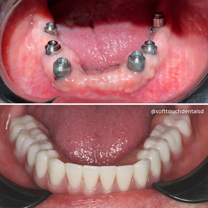 All On Four Before and After 06
