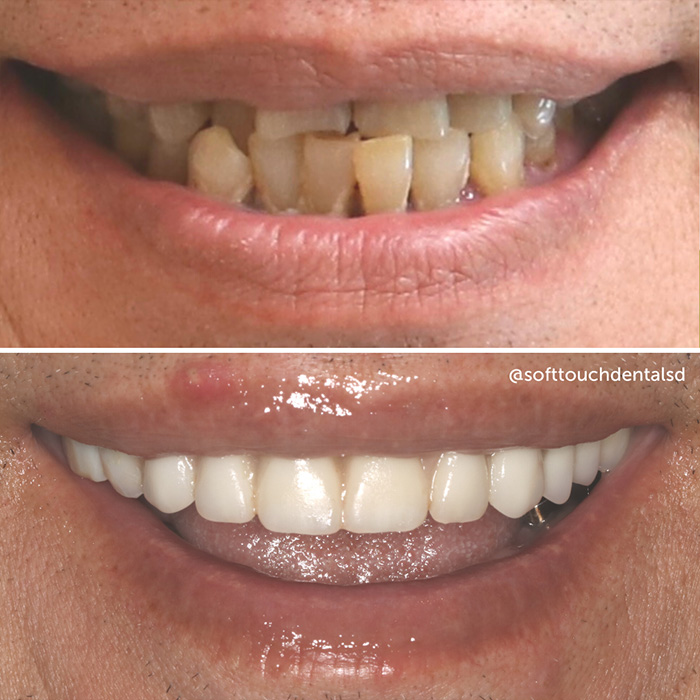 All On Four Before and After 06