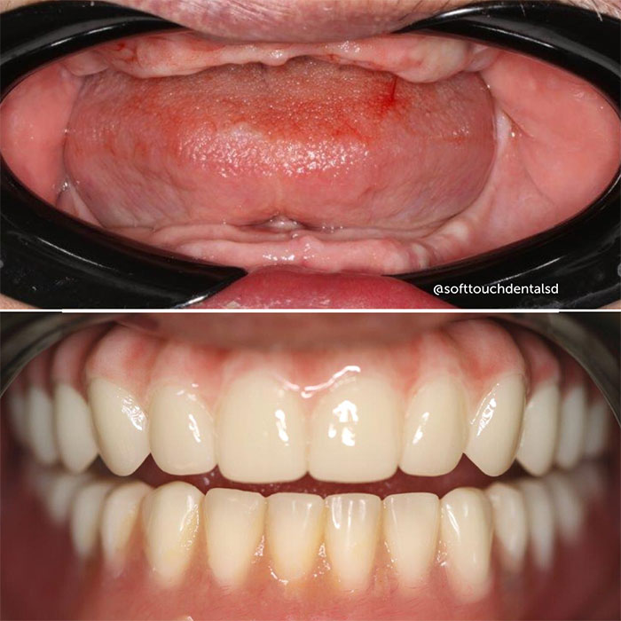 All On Four Before and After 06
