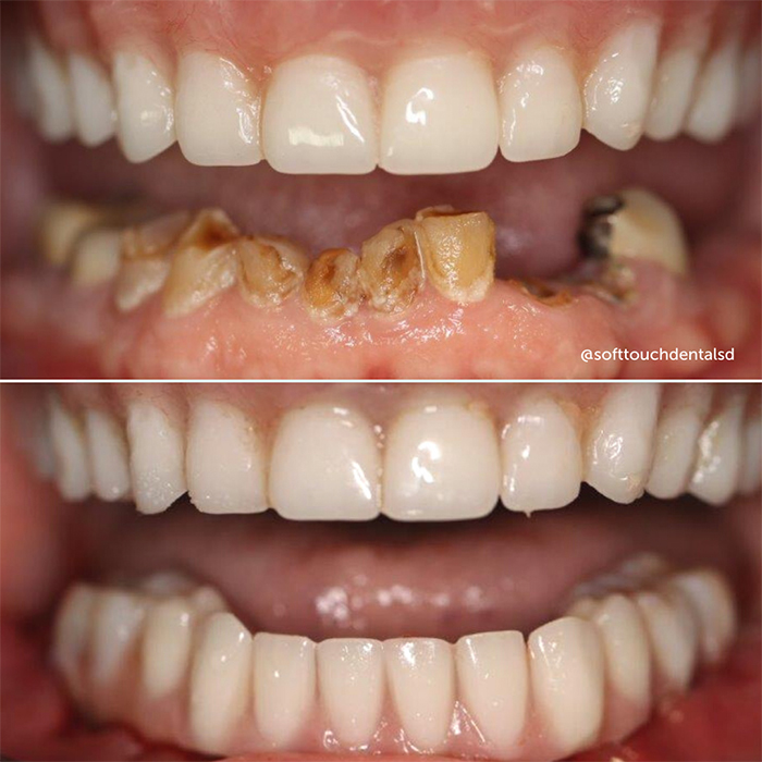 All On Four Before and After 06