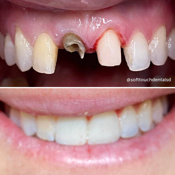 Broken And Missing Teeth Before and After 02