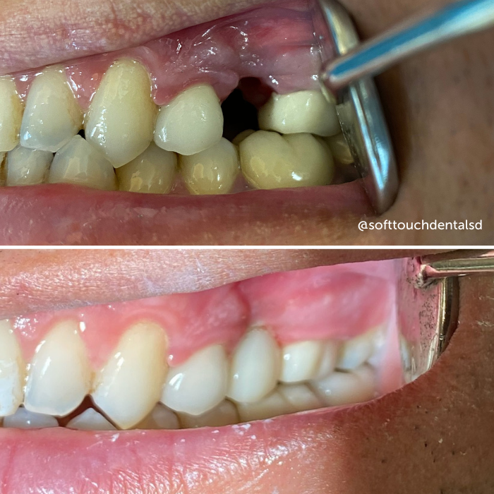 Broken And Missing Teeth Before and After 02