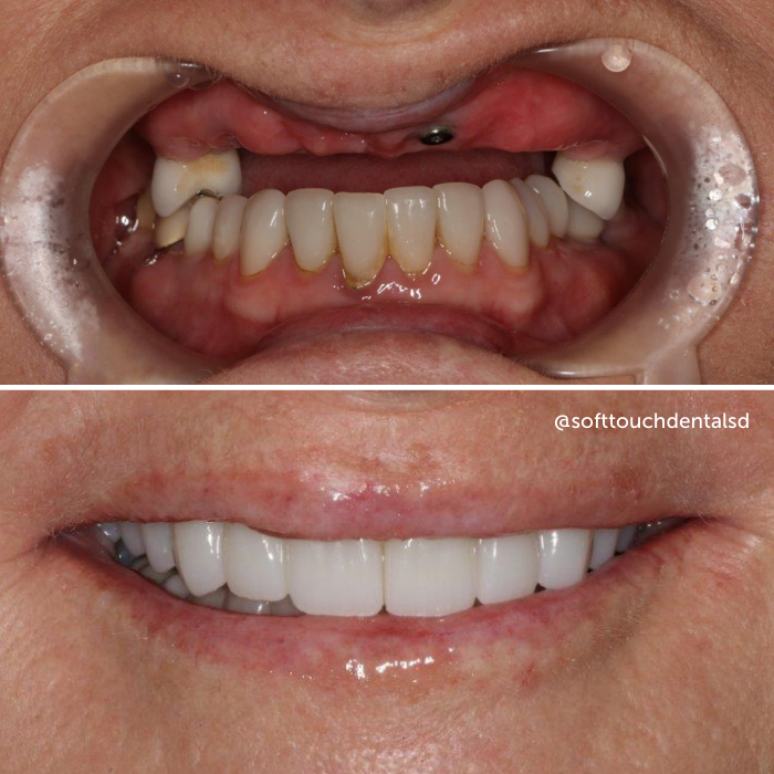 Should my teeth be touching