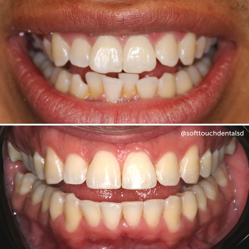Orthodontics Before and After 03