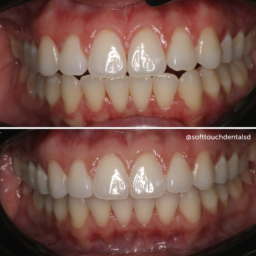 Orthodontics Before and After 03