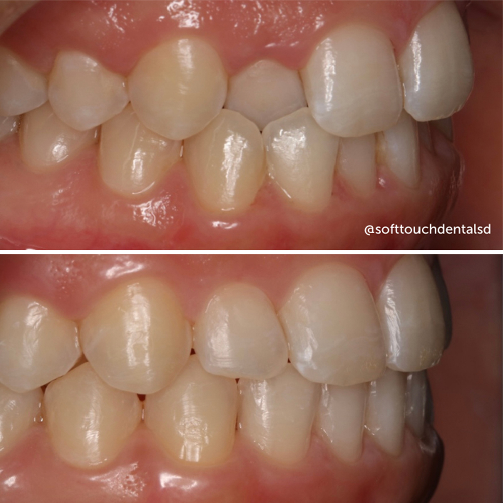 Orthodontics Before and After 03