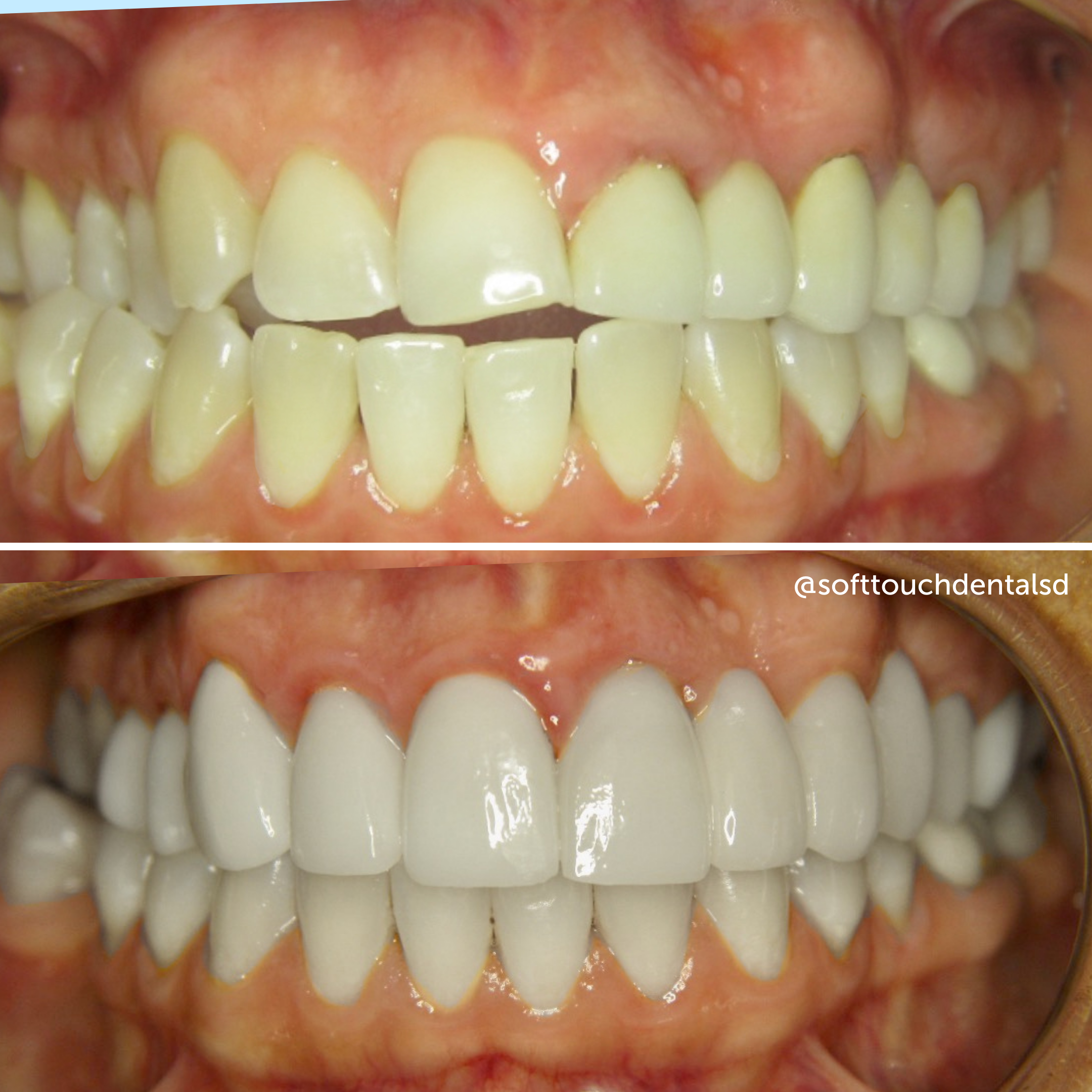 Veneers Before and After 03