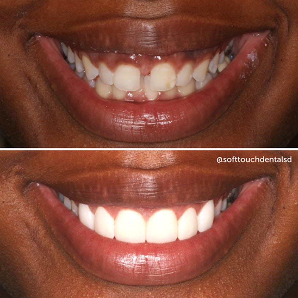 Veneers Before and After 03