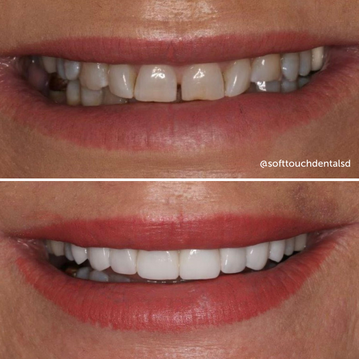 Veneers Before and After 03