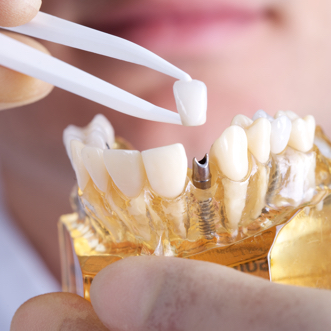 Dental Implants example