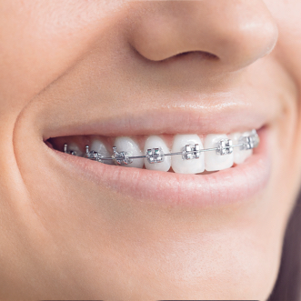 Smile with braces